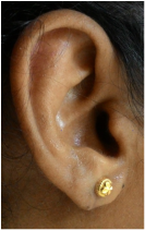 Ear lobe repair with Plastic Surgery - AMICUS CLINIC