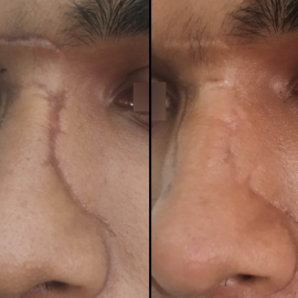 Scar revision before and after